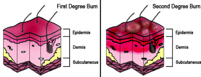 Graph showing the different degrees of skin burn