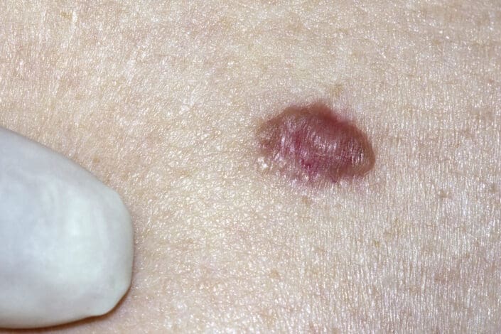 basal cell carcinoma picture