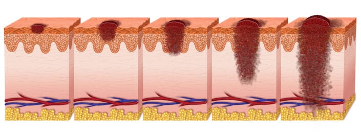 melanoma graph